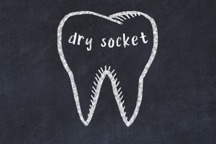 Dry Socket Gums