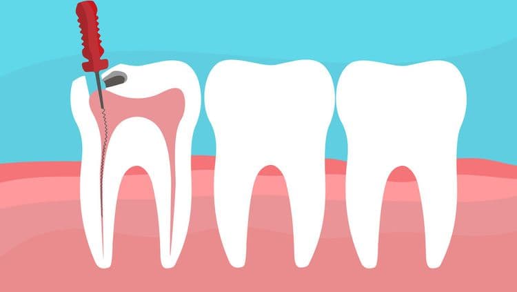 How Long Does a Partial Root Canal Last