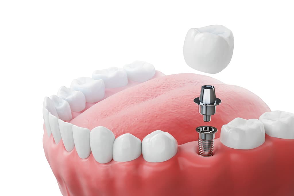 Latest Dental Implants