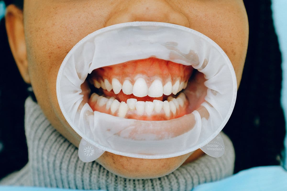 person-with-dental-cheek-retractor.jpg