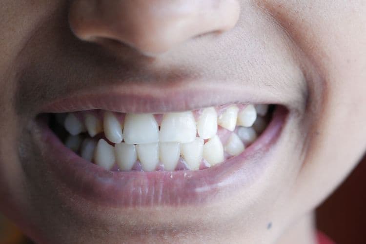 Teeth Shifting After Age 30